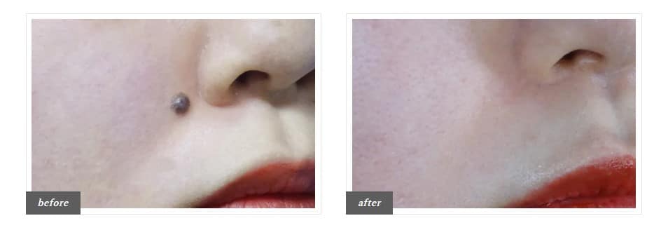 TCBほくろ除去症例写真