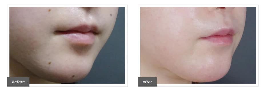 TCBほくろ除去症例写真