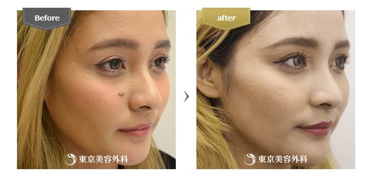 東京美容外科ほくろ除去症例写真