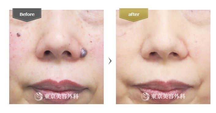 東京美容外科ほくろ除去症例写真